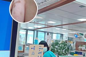 卤米松乳膏用多久需要停