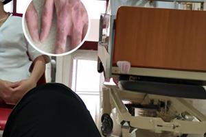 兰州哪家医院治疗白斑