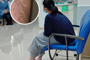 兰州中研白癜风医院是否正规