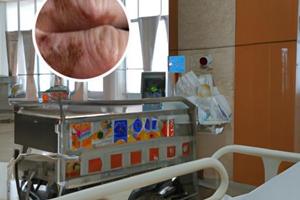 兰州中研白癜风医院检查费用
