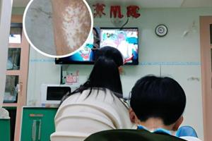 兰州中研治疗白斑多少钱