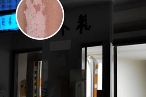 兰州白斑十佳医院