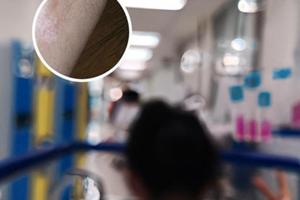 他克莫司软膏和卤米松乳膏一起用先抹哪个