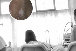 吡美莫司乳膏治白斑吗