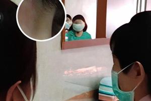 他克莫司软膏能擦多长时间
