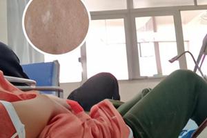 吃他克莫司手会麻麻的吗