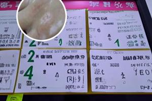 巴瑞替尼用药感受