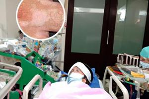他克莫司软膏14岁孩子能涂吗