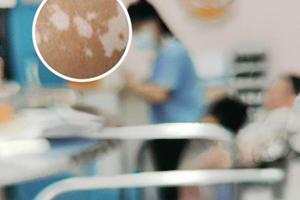 补骨脂外用的方法和用量
