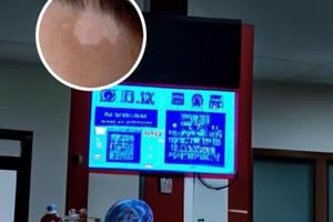 泼尼松白斑治疗周期多久