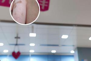 吡美莫司乳膏是治疗什么病的