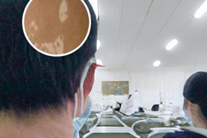 他克莫司软膏应该用多久