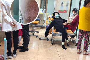 巴瑞替尼治疗什么病