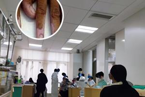 乌龙散对白癜风有没有用