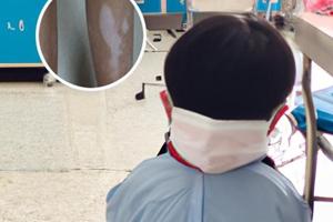 卤米松乳膏能治疗白斑吗