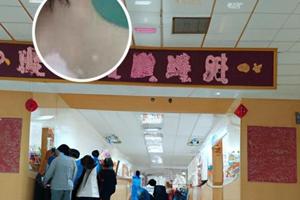 他克莫司用了脸像在烧正常吗