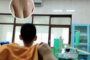 他克莫司软膏治疗白癜风怎么样