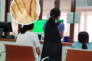 他克莫司治疗面部白斑