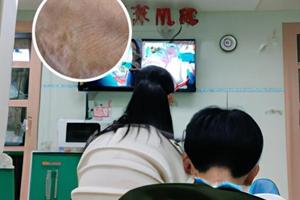 他克莫司软膏擦几天后好