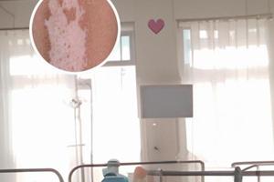 吡美莫司乳膏治疗白斑突然停下来会怎样