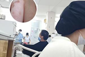 抹他克莫司软膏注意事项