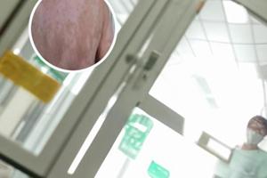 硫酸羟氯喹片有副作用吗