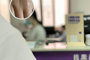 卤米松乳膏跟他克莫司可以交替使用吗