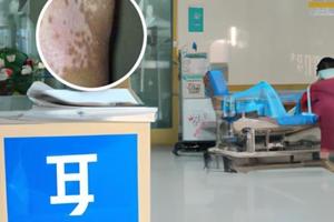 醋酸泼尼松片用法