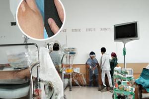 阿昔洛韦乳膏只能用7天吗