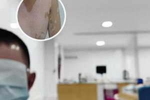 他克莫司浓度高了有什么症状