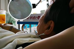 卤米松乳膏连续用两个月要紧吗