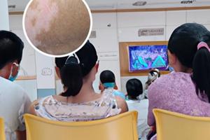 他卡西醇软膏治疗白斑