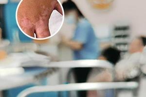 白癜风涂了他克莫司后痒