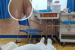 卤米松乳膏作用好吗