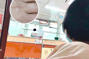 卤米松乳膏可以用几天