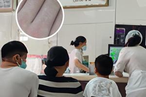 他克莫司软膏能治白斑吗怎么用