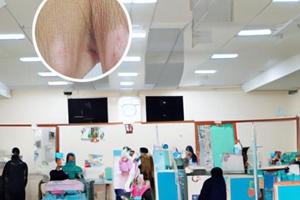 他克莫司软膏可以抹多久