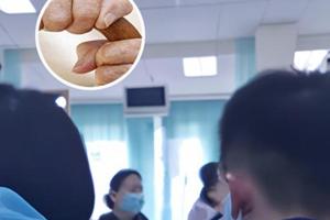 卤米松乳膏可以用手擦吗