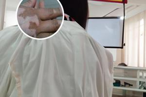 巴布期喷剂治白斑多长时间见效