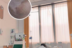 卤米松三氯生乳膏是激素吗