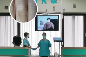他克莫司治疗白斑要用多久