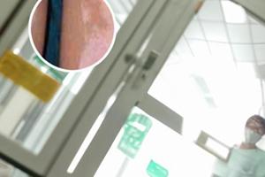 0.1%他克莫司软膏普特彼