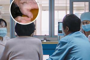 肝素钠乳膏治疗白点病有用吗