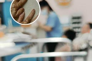 他克莫司药膏该怎么涂抹正确