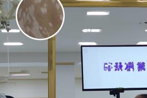 他卡西醇软膏治疗白斑白天能抹吗