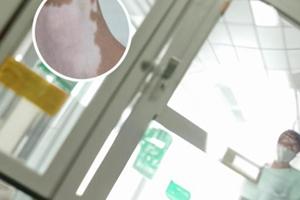 卤米松乳膏治疗白斑好以后还继续用多久
