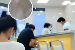 他卡西醇软膏用了几天没效果
