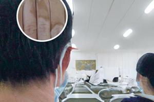 卡泊三醇擦剂用与白癜风多久有效果