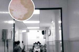 卤米松乳膏治白斑吗怎么用