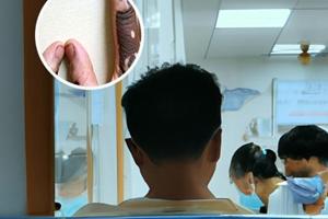复方斑蝥胶囊效果